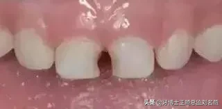 什么是预成冠?儿童乳牙的保护伞