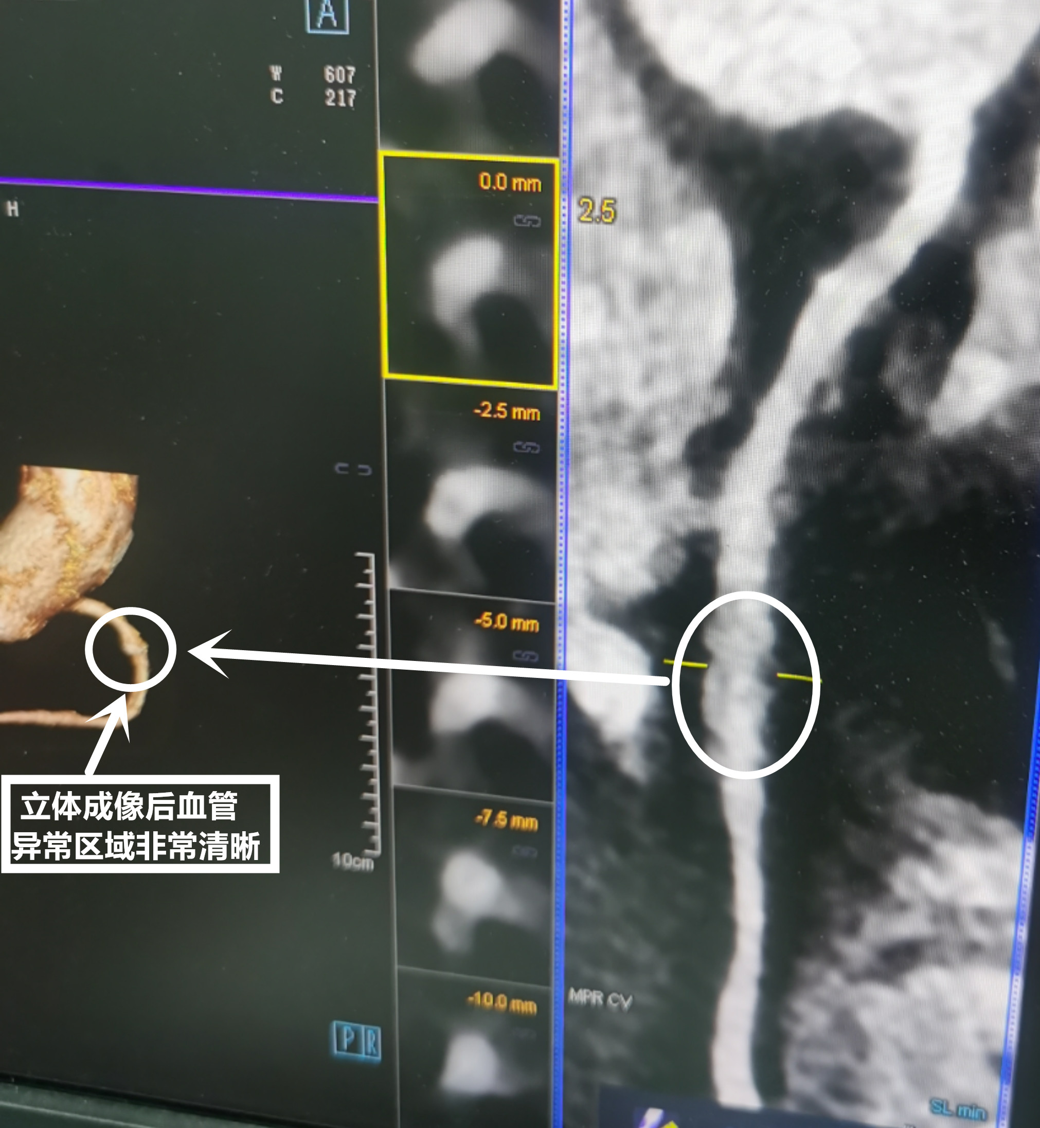 能“解”痛风结晶，会“算”血管狭窄，武汉市肺科医院引入会解方程的双源CT