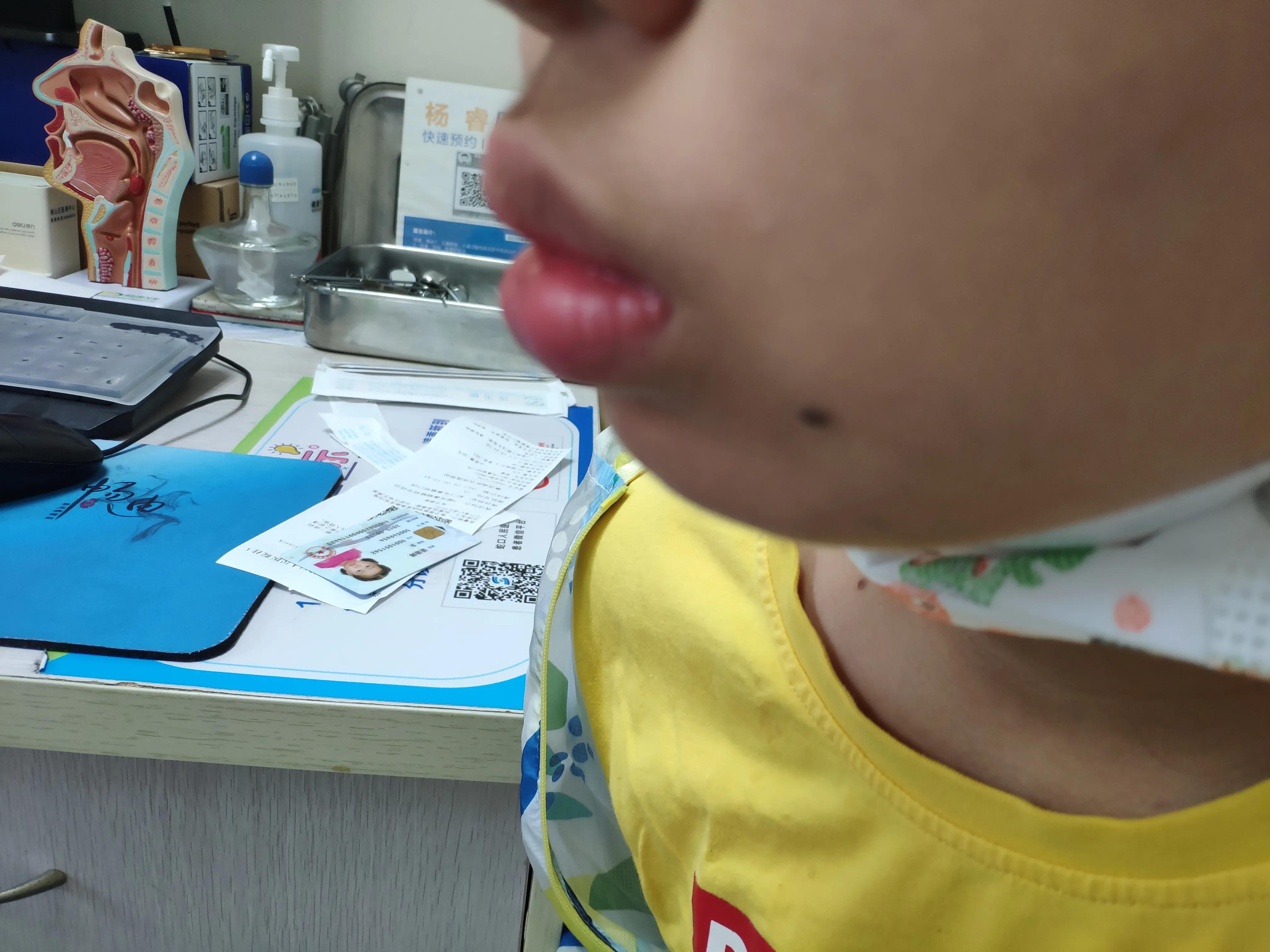 腺样体得了腺样体面容越长越丑