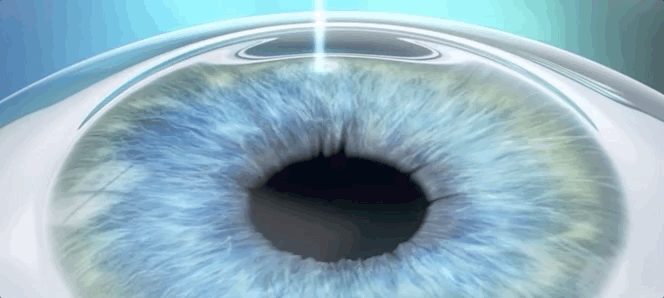 科普：一篇文章详述激光近视矫正手术的那些知识