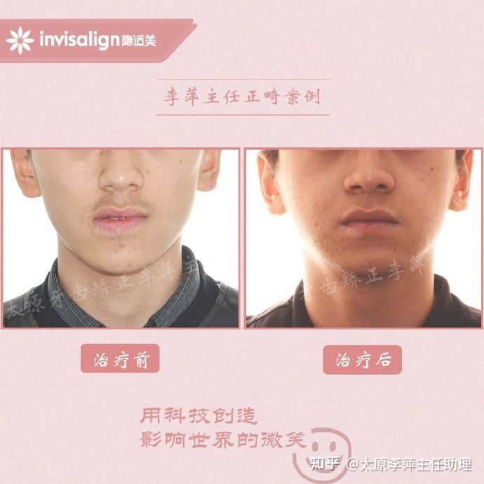 太原牙齿矫正：隐形牙套效果好不好？看这些病例你就知道了