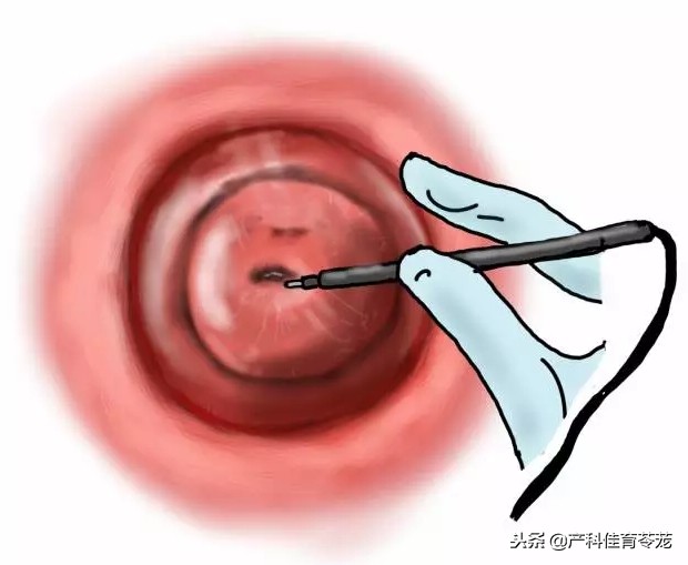 宫颈上的囊肿,多数不需治疗