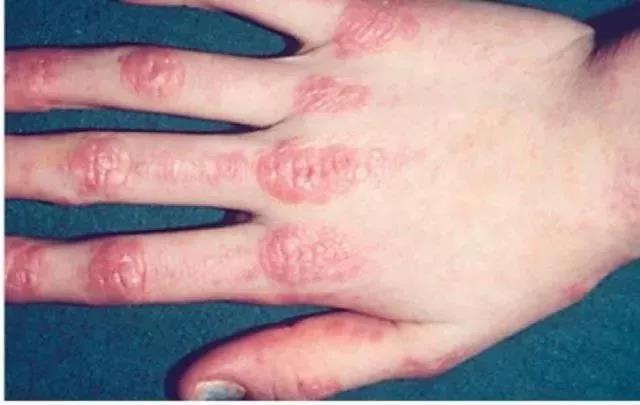 一文了解儿童皮肌炎与多发性肌炎的特点