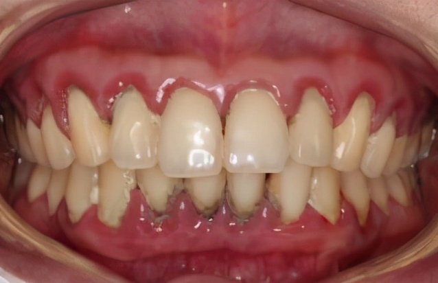 牙周炎有什么症状