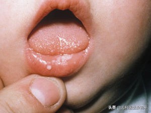 孩子嘴里有一层白膜，其实是鹅口疮，教你几招搞定无烦恼