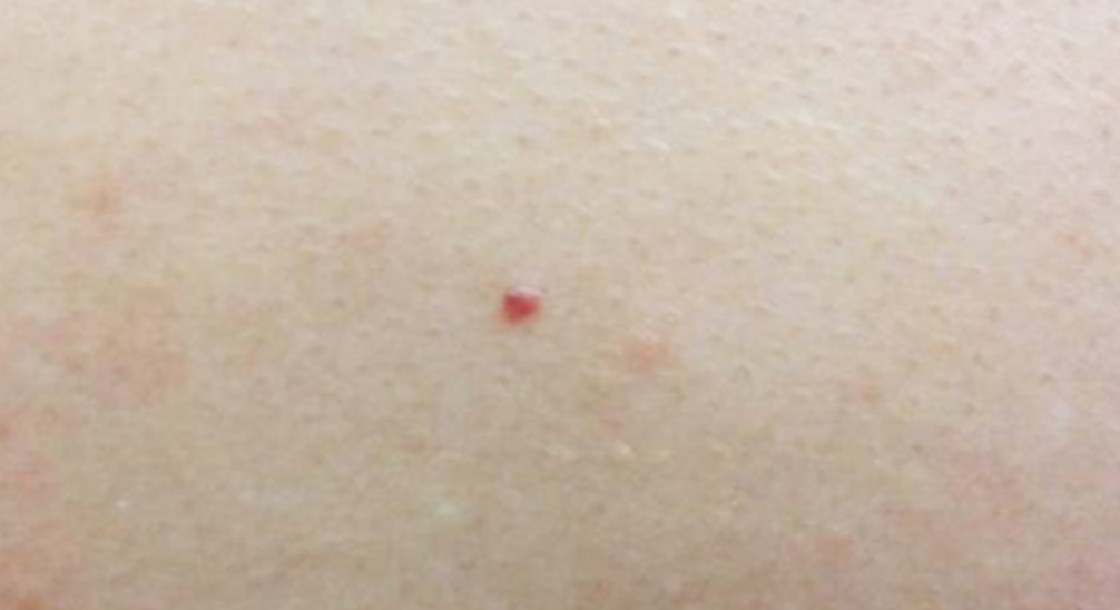 身上出现很多小红点，像小红痣，不痛不痒是怎么回事？
