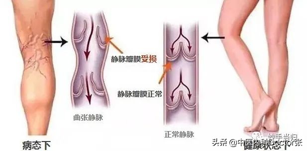 老人双脚水肿？一按一个凹？中医专家教你1个办法去水肿