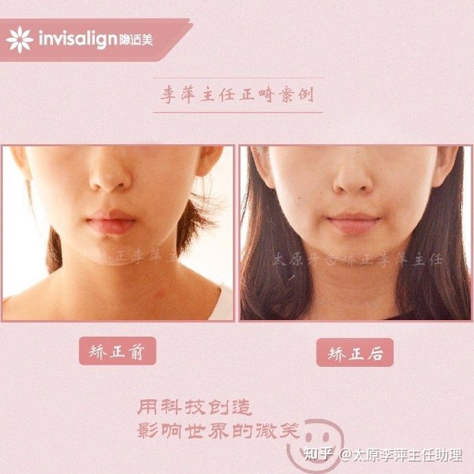 太原牙齿矫正：隐形牙套效果好不好？看这些病例你就知道了