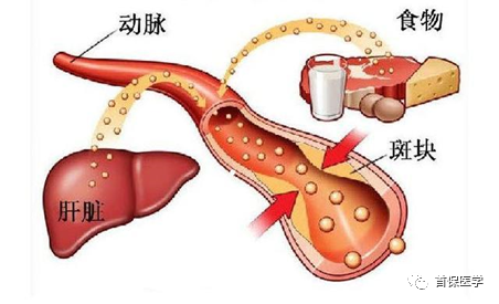 体检时你的总胆固醇正常，而低密度脂蛋白偏高，需要治疗吗？