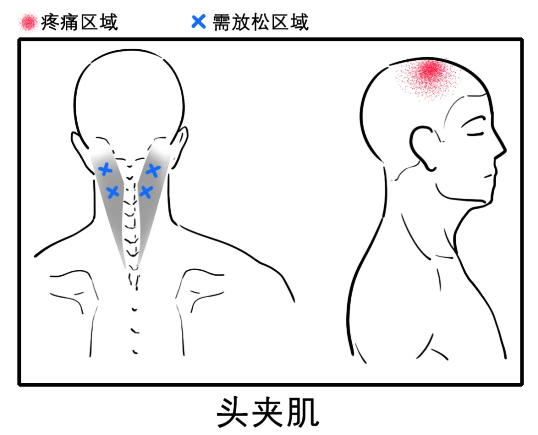 八成头痛和颈椎有关!一份“疼痛位置图解”帮你对症放松
