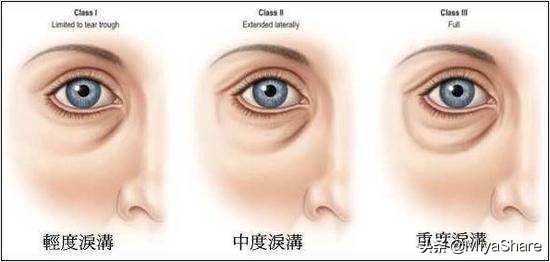醒醒吧：什么眼霜都救不了黑眼圈！6款眼霜分析：这2款又贵又没用