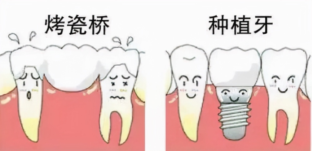 「牙齿那些事儿」No.47丨疼痛分12级，种植牙的疼痛等级是？