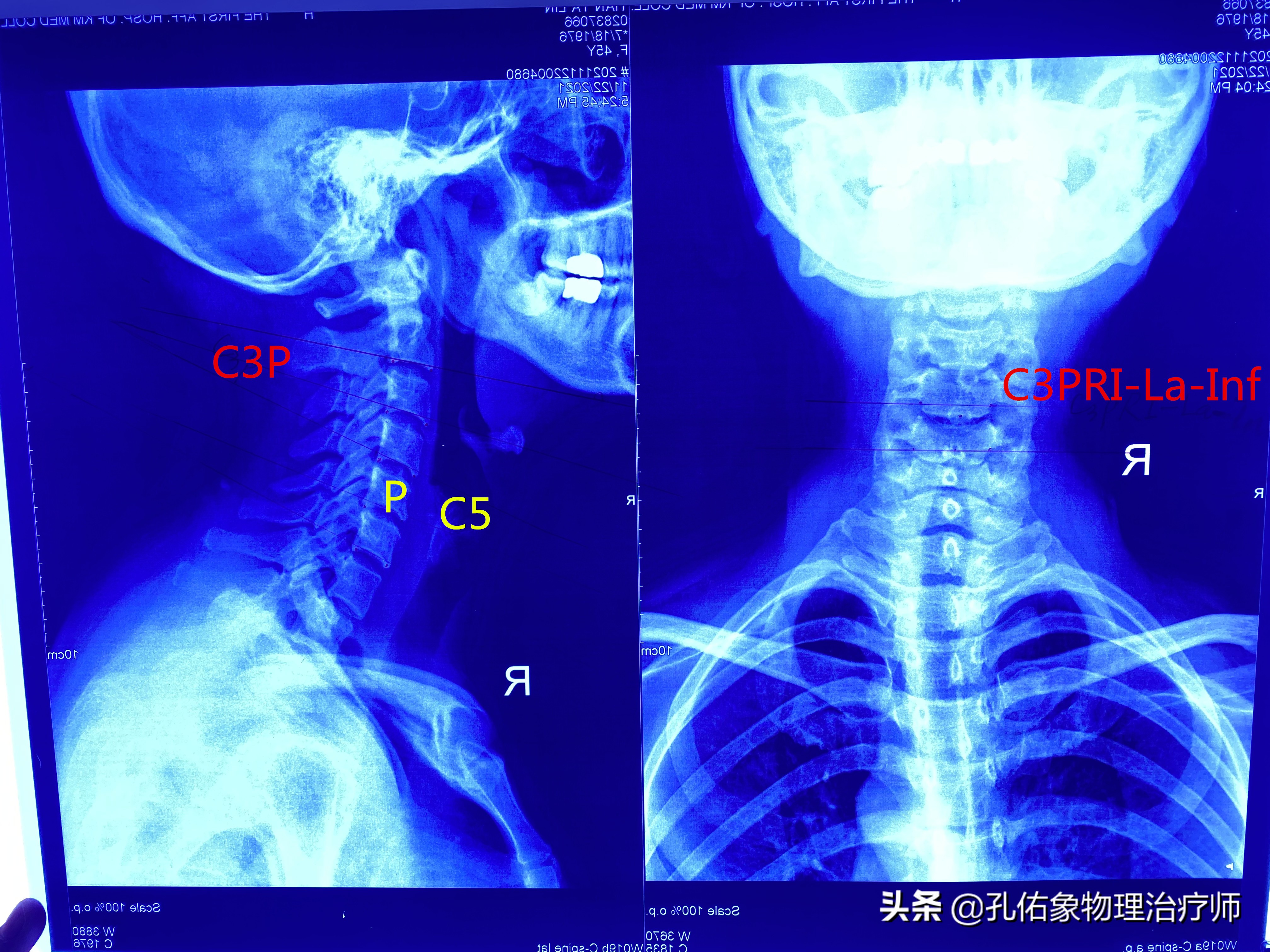 肩膀及肩胛骨内侧缘疼痛，是怎么回事？要如何治疗？请看此文