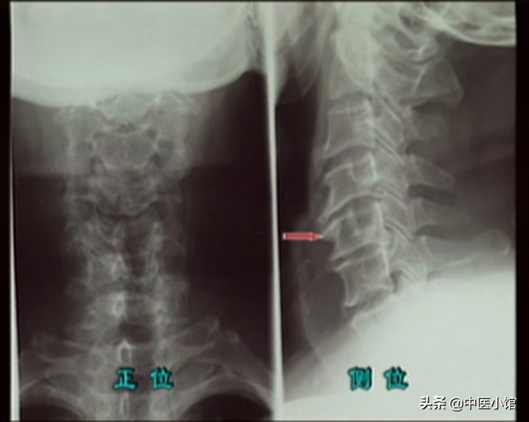 颈椎病怎么查体，怎么治疗，细节来了