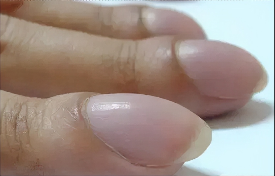 杵状指见于什么病(作为疾病较典型体征) - 百百科