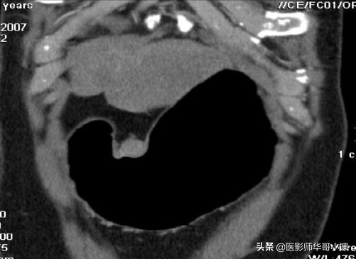 胃，3D立体重建技术，还您一个实实在在的胃。网友：价格多少呢