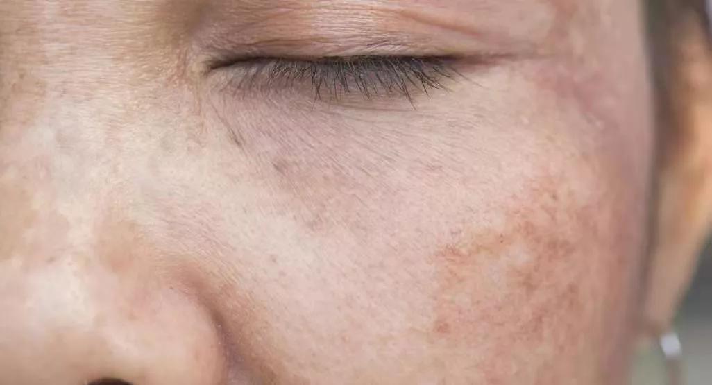 如何祛除黄褐斑(祛除黄褐斑的正确的处理方法) - 家电维修网