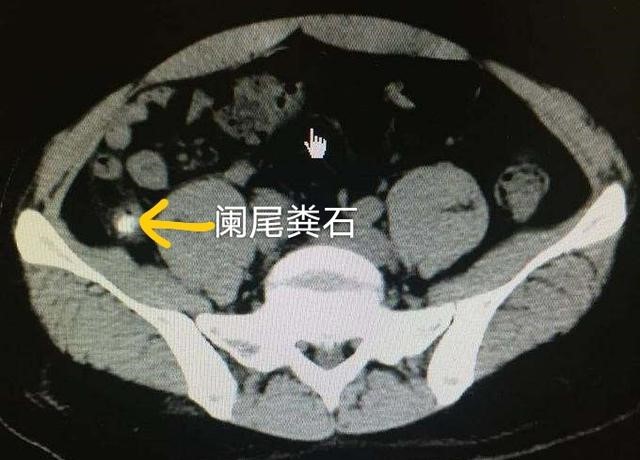 急性阑尾炎一定要手术吗?选择开刀？还是腹腔镜手术?