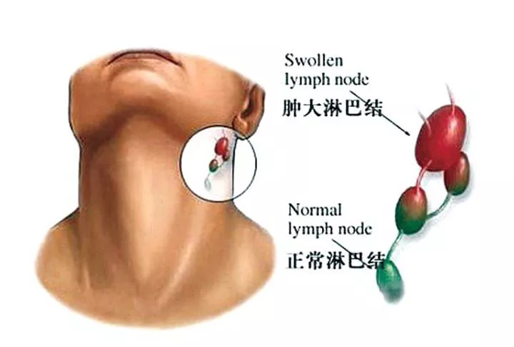 淋巴結腫大