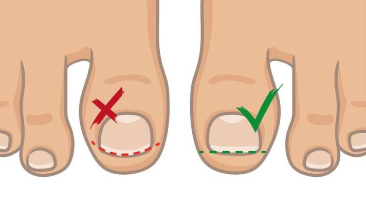 指甲月牙少,有白点,竖线,身体怎么了?6个小变化别忽视,可能是癌症提示