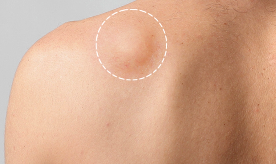 女性肩膀大脂肪瘤图片图片