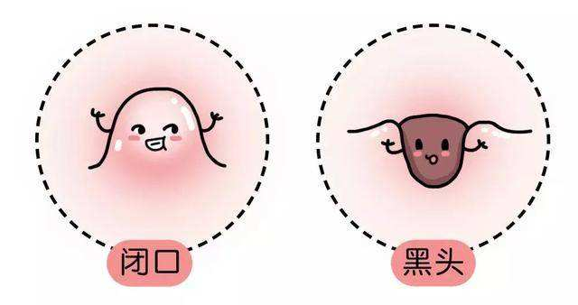 你脸上长的小疙瘩是闭口还是黑头？什么是闭口，哪些产品能祛除？