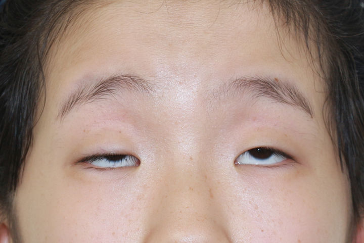 做上睑下垂矫正手术是一种什么体验呢？