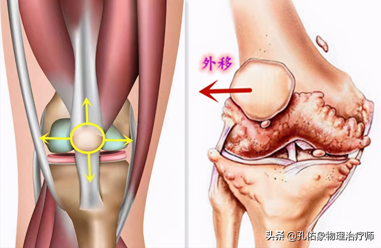 大腿根内侧痛是怎么回事(膝关节疼痛的元凶是什么)