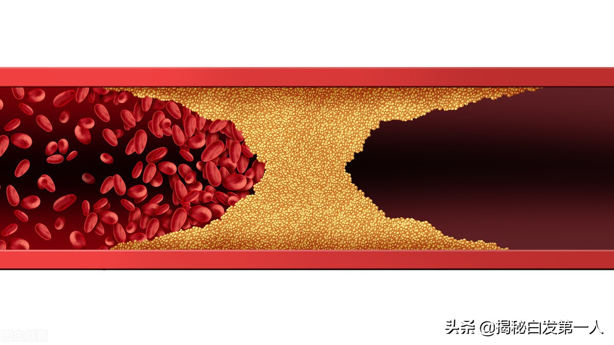 腔隙性脑梗塞与腔隙性脑梗死的正确读法及区别解析