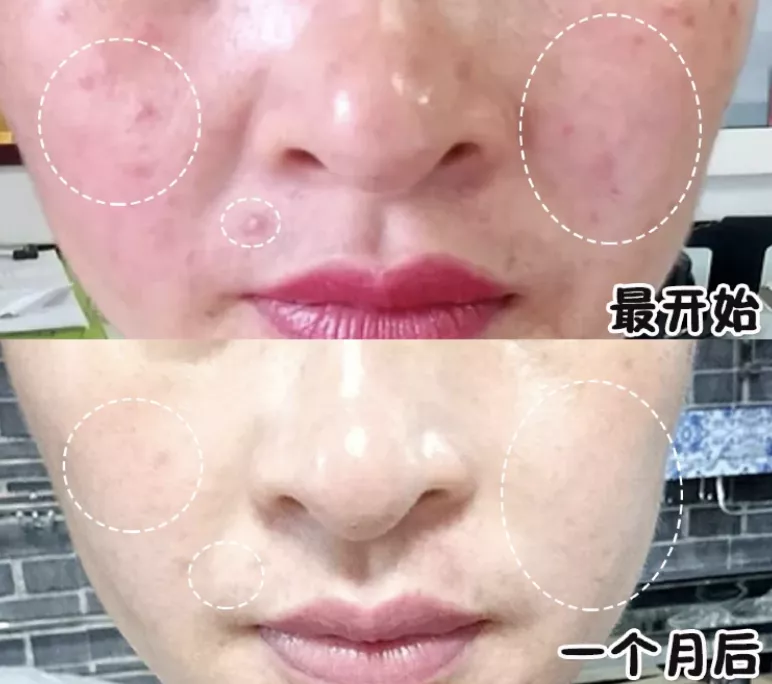 荣晟医用冷敷贴效果怎么样,好用吗