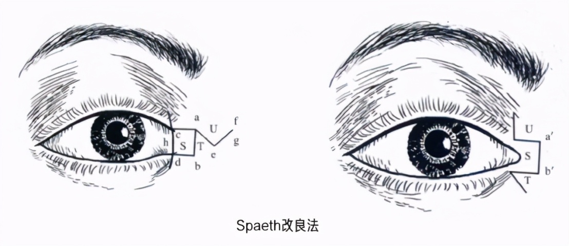浅谈内眦赘皮之——如何避免开内眼角术后留疤