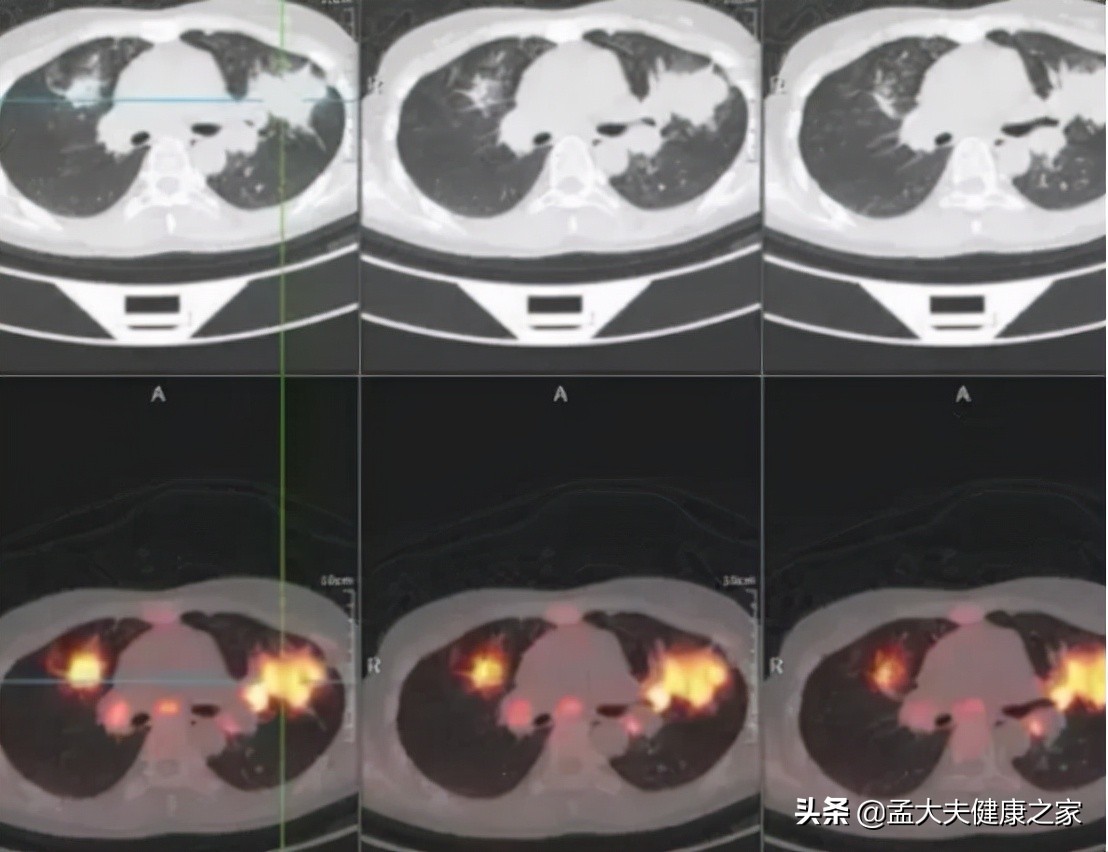 HPV疫苗能够“治疗”HPV阳性使其转阴吗？该如何预防HPV感染？