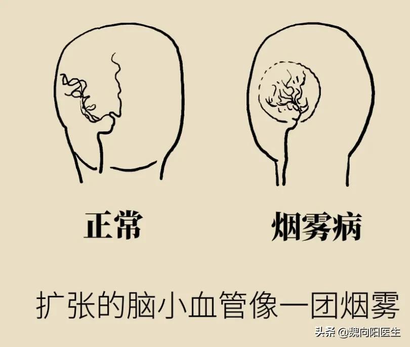 烟雾病是个什么病？只有老年人才得？很多年轻人和小孩也有烟雾病