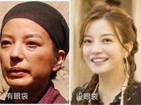 要不要手术“祛眼袋”?医生讲解手术后遗症,网友:不敢去了