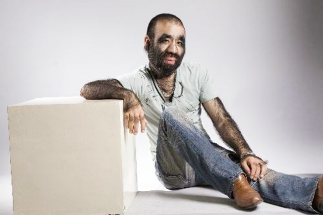 毛孩于震寰,出生就被研究,被女友母亲要求脱毛,42岁娶90后娇妻