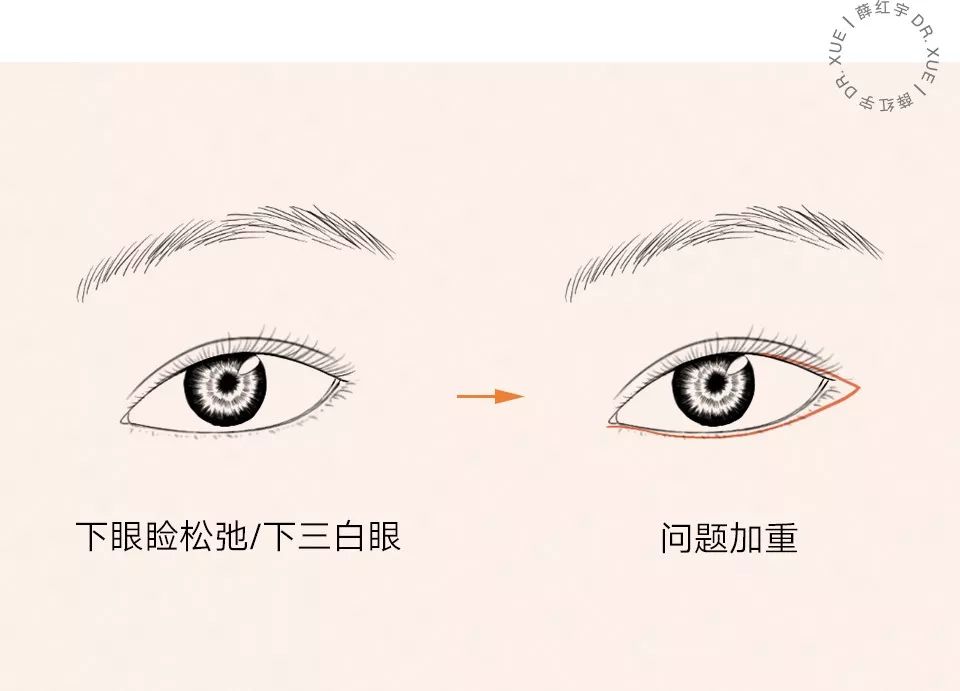 要不要开外眼角？要不要做眼睑下至？