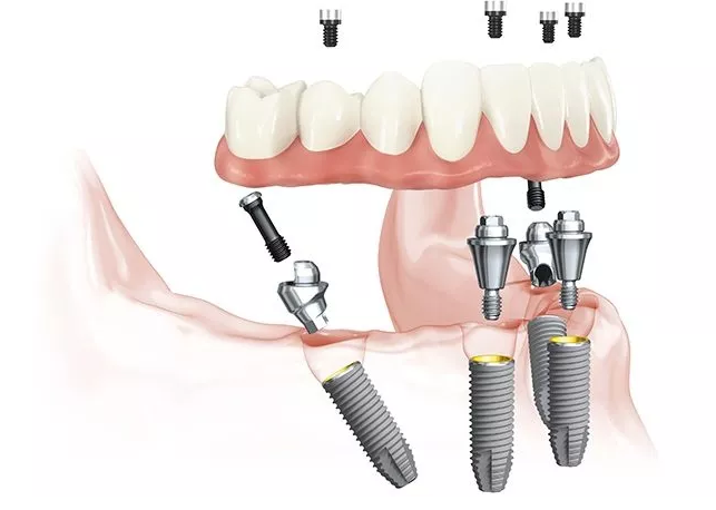 半口缺牙患者的福音，ALL ON 4技术到底怎么样？听听牙医的分析
