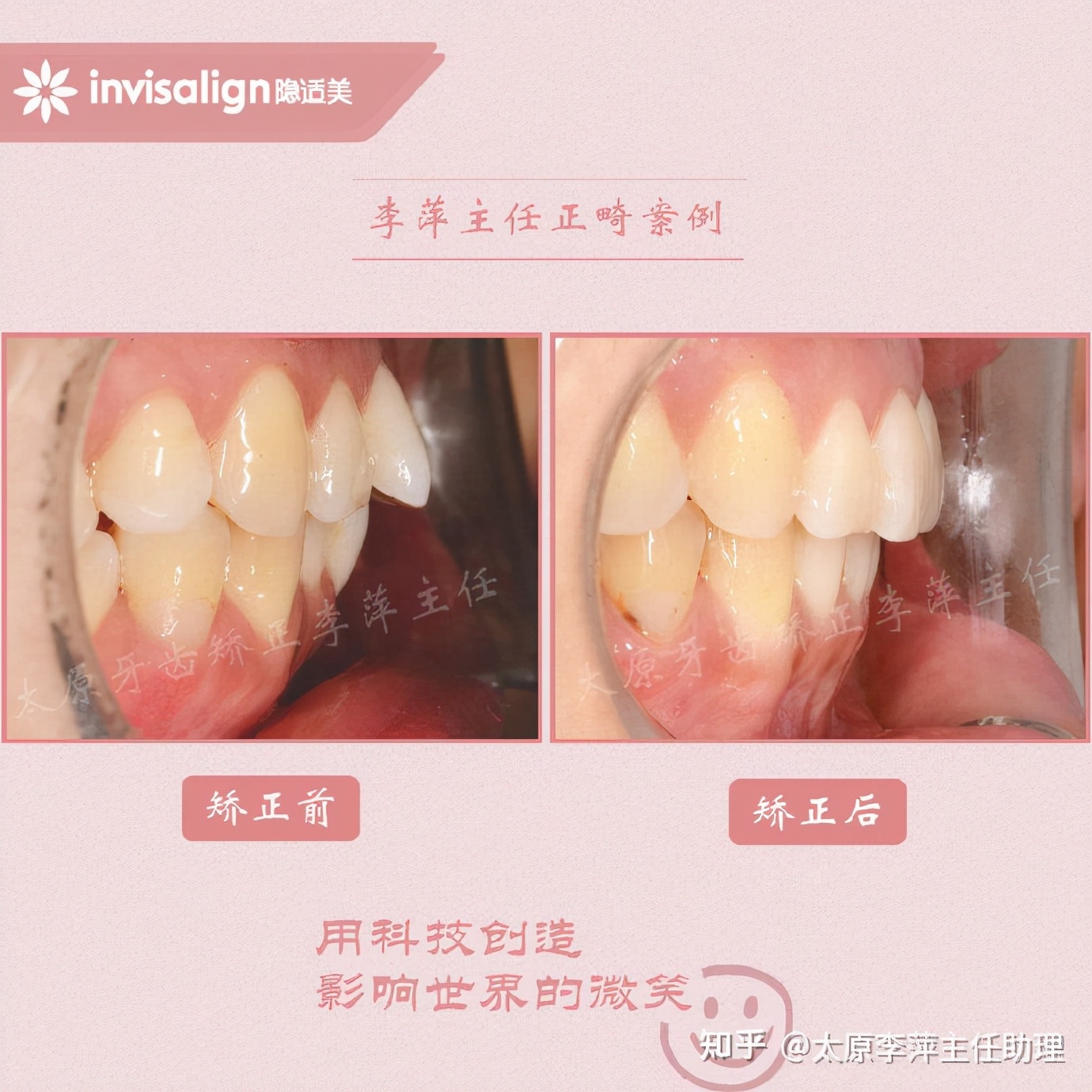 太原牙齿矫正：隐形牙套效果好不好？看这些病例你就知道了