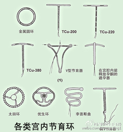 关于节育环那些事