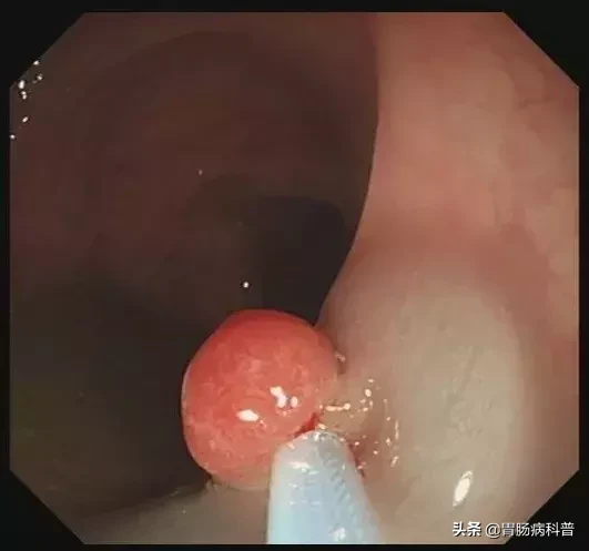医生是怎样切掉肠息肉的?