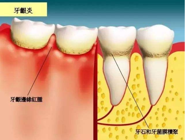 出现牙龈萎缩怎么办？它能自己长回去吗？看看牙科医生怎么说