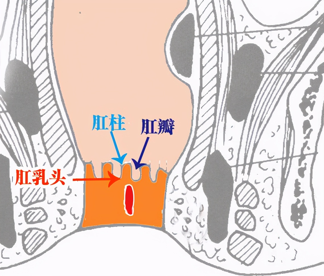 前哨痔和肛乳頭水腫那麼這個很好理解,不解釋肛裂,就是肛管裂