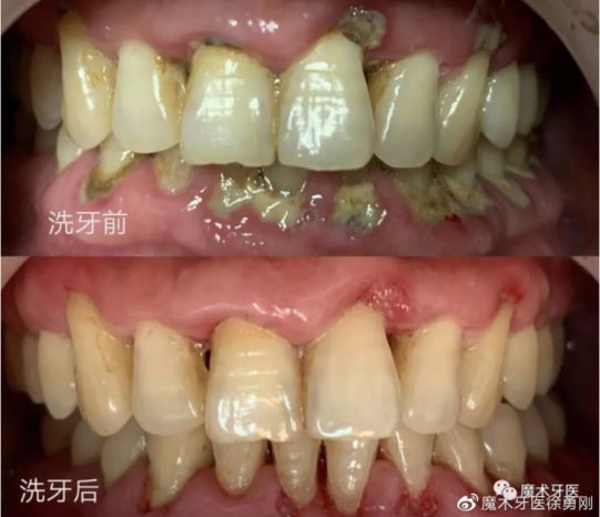 牙周炎，中国人后半生无法摆脱的痛