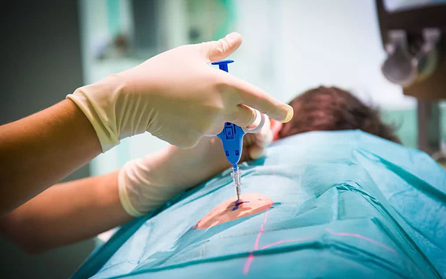 活检怎么做（什么是肾活检）