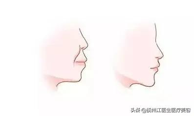 长期抿嘴会改善凸嘴吗，如何矫正嘴凸？
