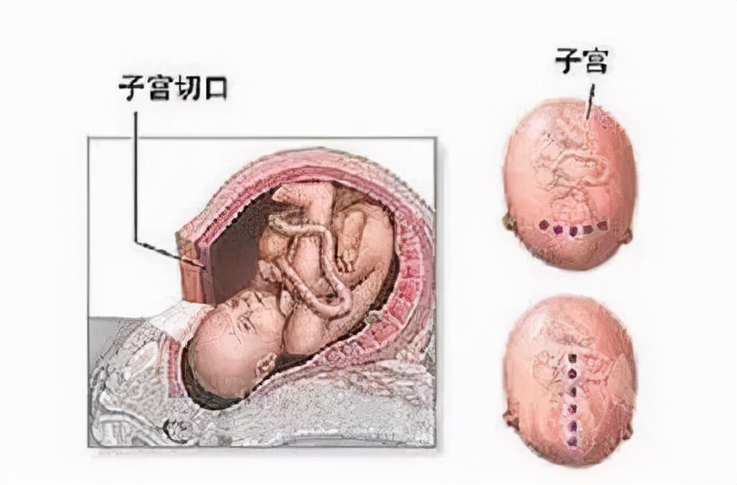 疤痕子宫——再次生育，移植几个胚胎最好？