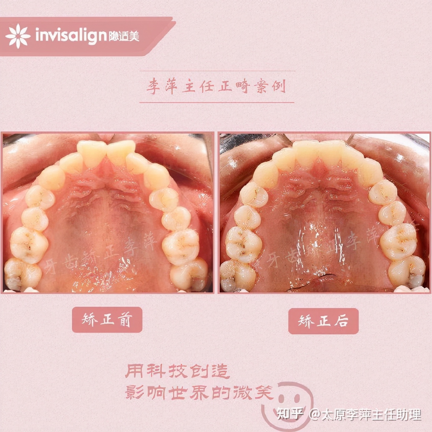 太原牙齿矫正：隐形牙套效果好不好？看这些病例你就知道了
