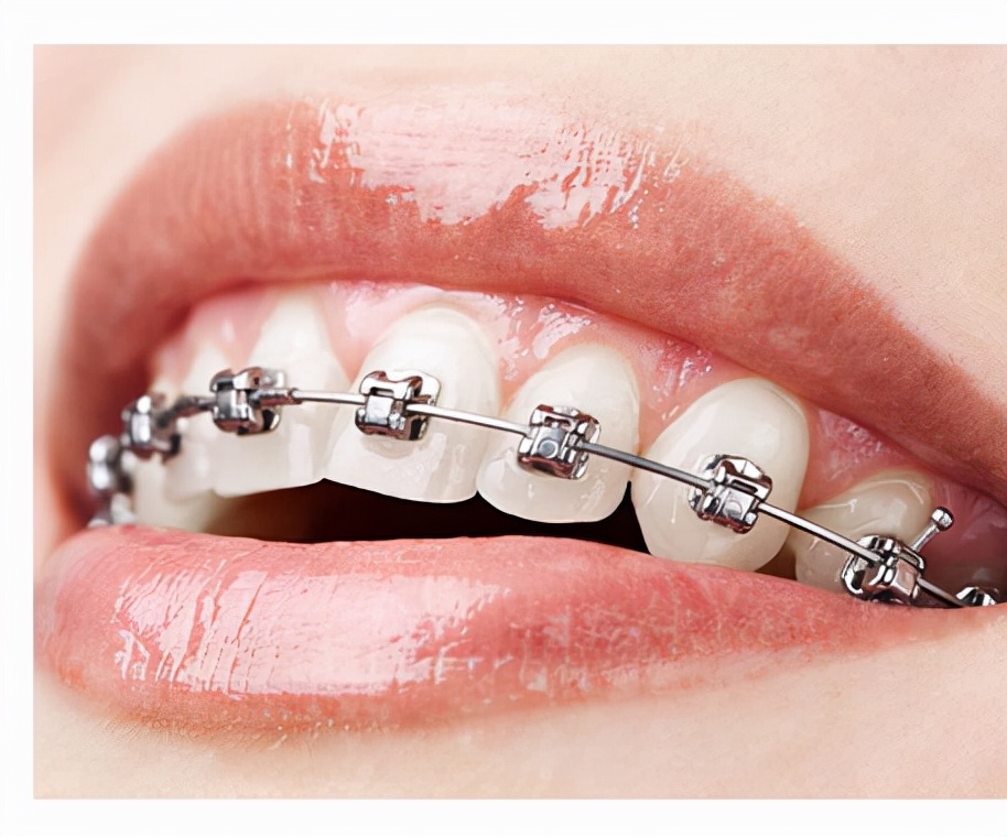 为什么牙齿矫正医生都不肯直接报价格？