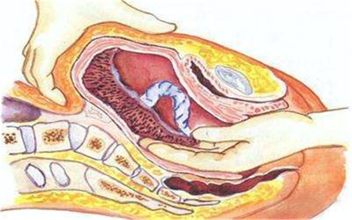 生完孩子胎盘不掉,医生伸手进产道掏,孕妈哭诉:过程太痛苦了