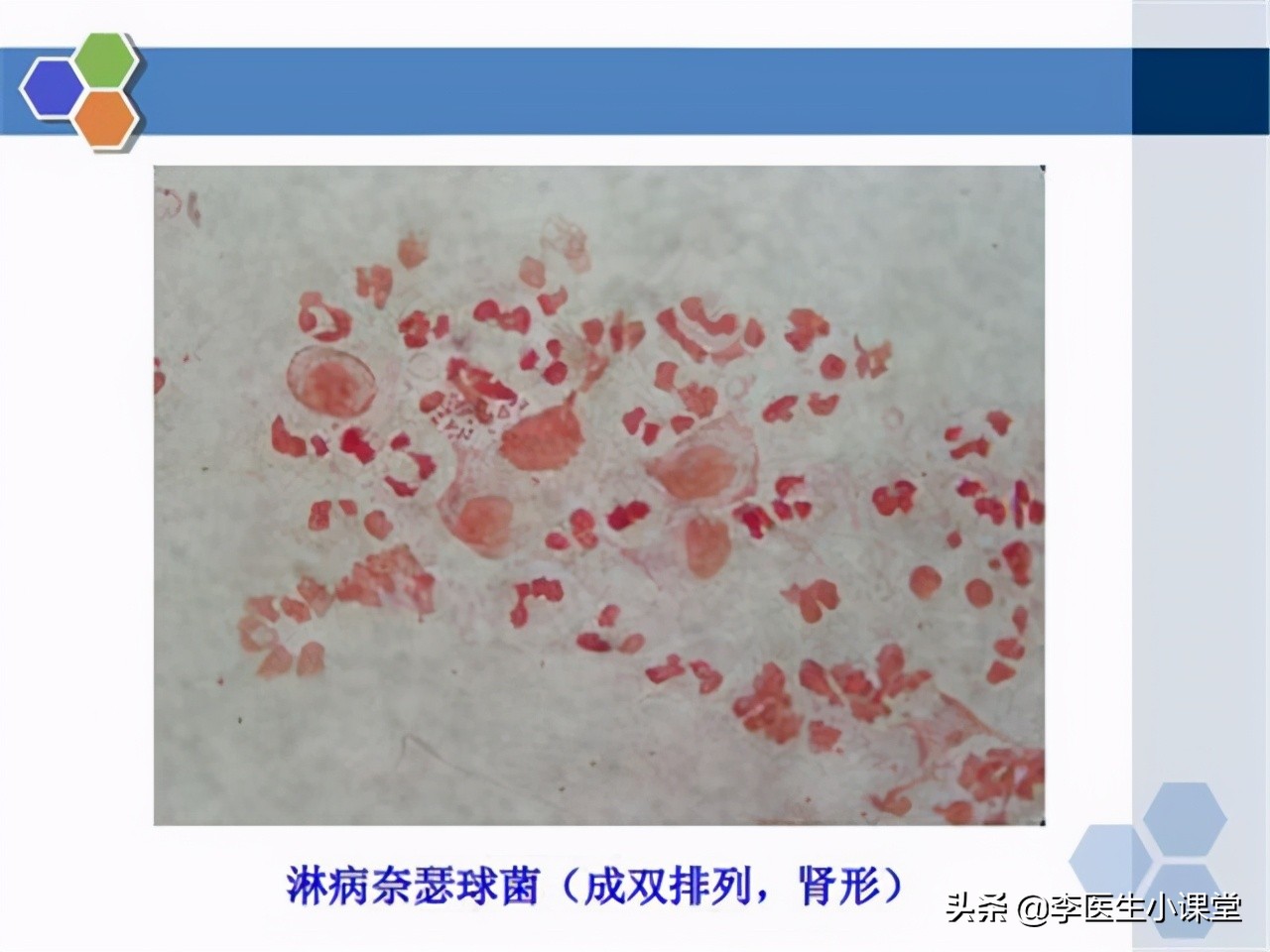 “淋病”是什么？如何治疗和预防？
